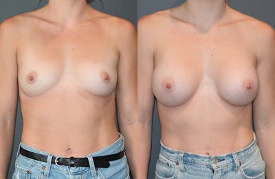 Breast Augmentation  Before & After Photos - Patient 149365403 - Image 1