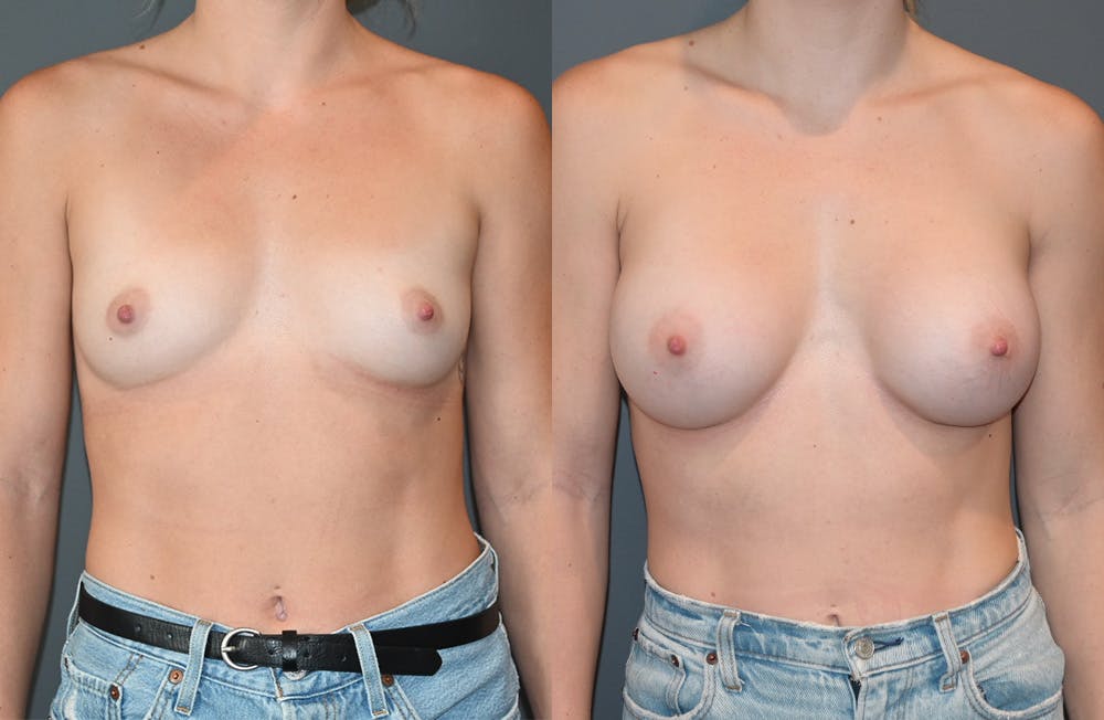 Breast Augmentation  Before & After Gallery - Patient 149365403 - Image 1