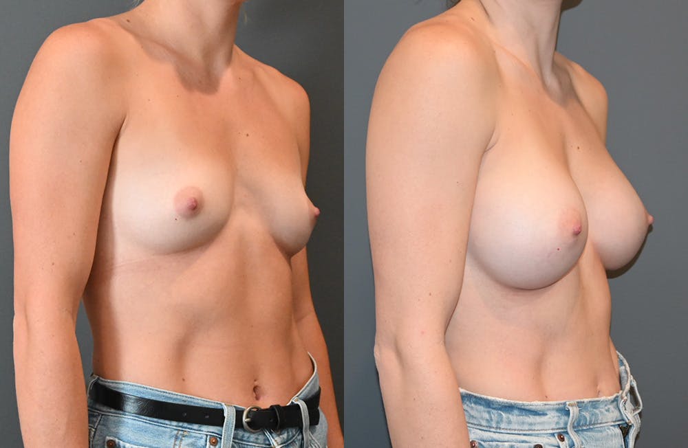Breast Augmentation  Before & After Photos - Patient 149365403 - Image 2