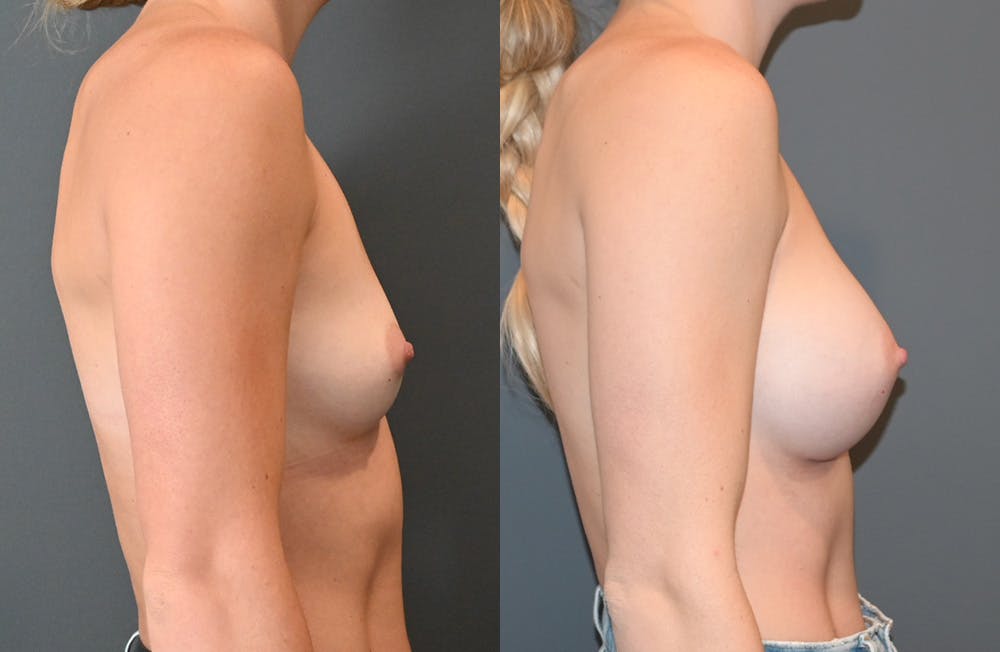 Breast Augmentation  Before & After Gallery - Patient 149365403 - Image 3