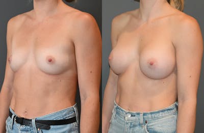 Breast Augmentation  Before & After Photos - Patient 149365403 - Image 4