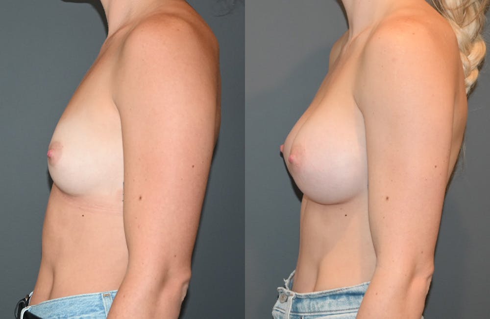 Breast Augmentation  Before & After Photos - Patient 149365403 - Image 5
