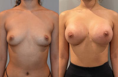 Breast Augmentation  Before & After Photos - Patient 149365402 - Image 1