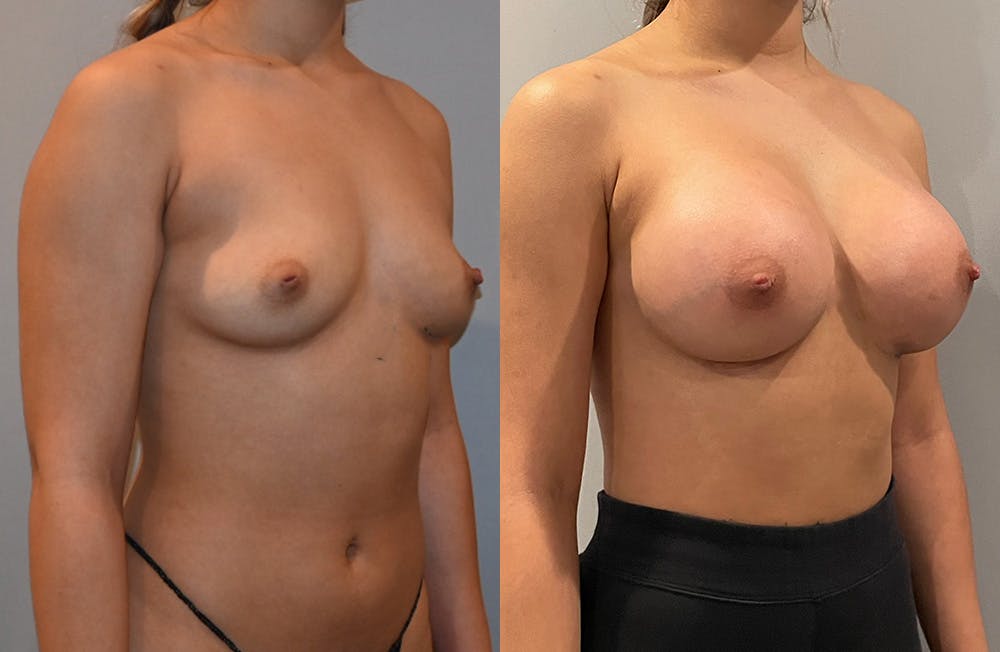Breast Augmentation  Before & After Photos - Patient 149365402 - Image 2
