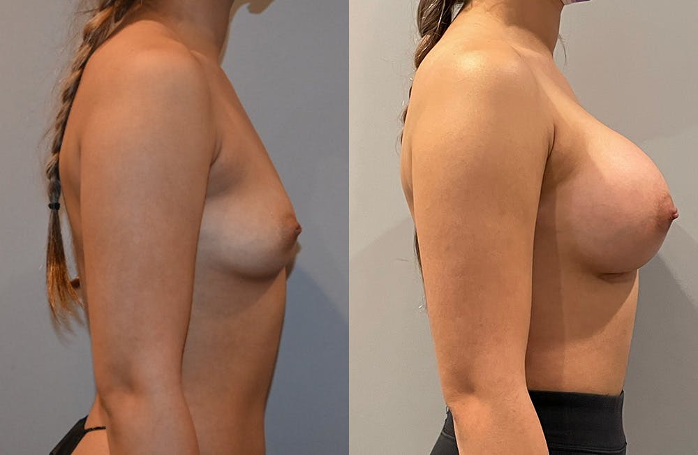 Breast Augmentation  Before & After Photos - Patient 149365402 - Image 3