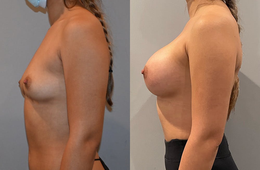 Breast Augmentation  Before & After Gallery - Patient 149365402 - Image 5