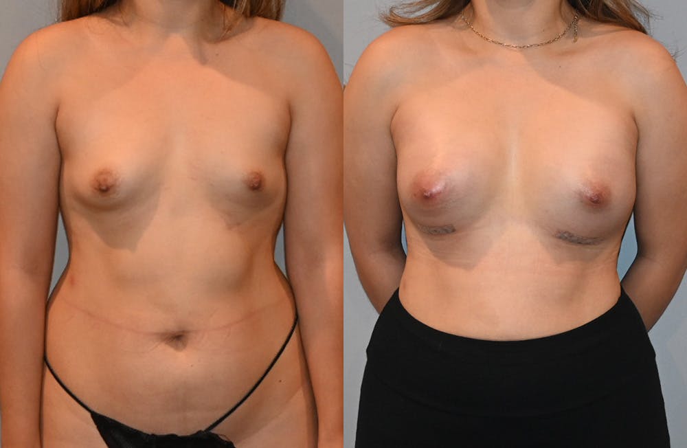 Breast Augmentation  Before & After Photos - Patient 149365401 - Image 1