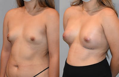 Breast Augmentation  Before & After Photos - Patient 149365401 - Image 2