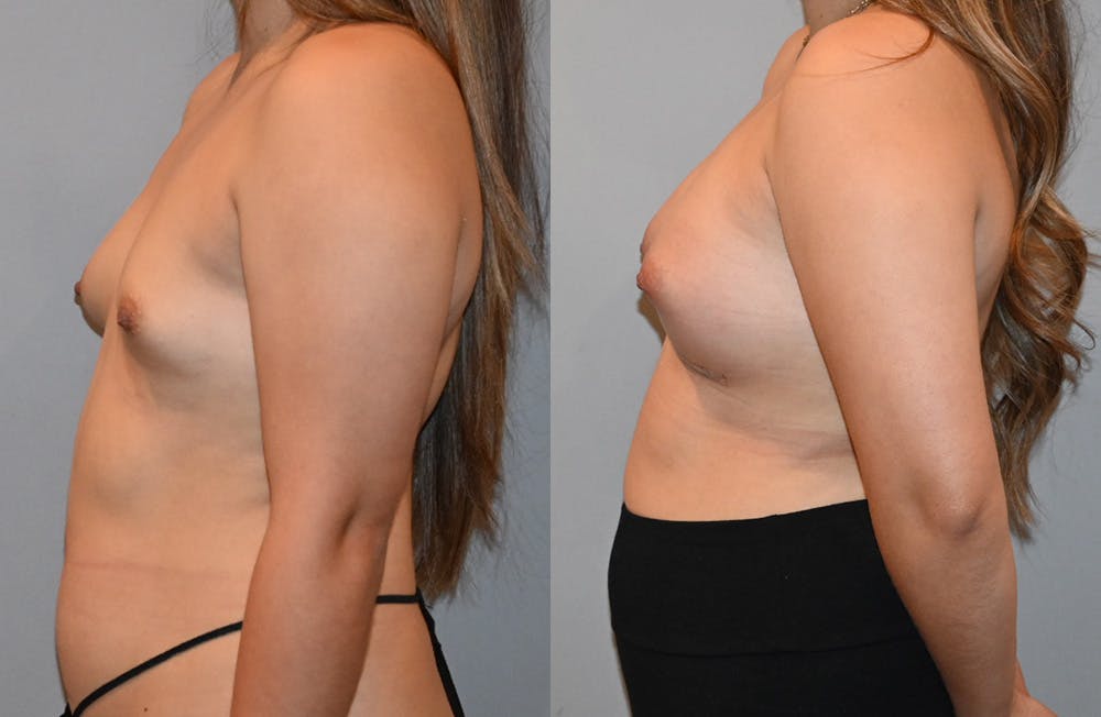 Breast Augmentation  Before & After Photos - Patient 149365401 - Image 3