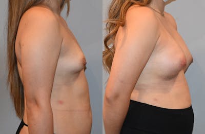 Breast Augmentation  Before & After Photos - Patient 149365401 - Image 4