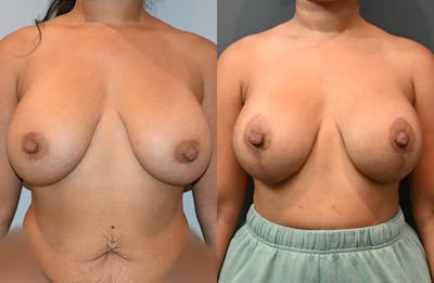 Breast Lift Before & After Photos - Patient 149365442 - Image 1