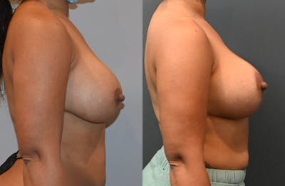 Breast Lift Before & After Gallery - Patient 149365442 - Image 2