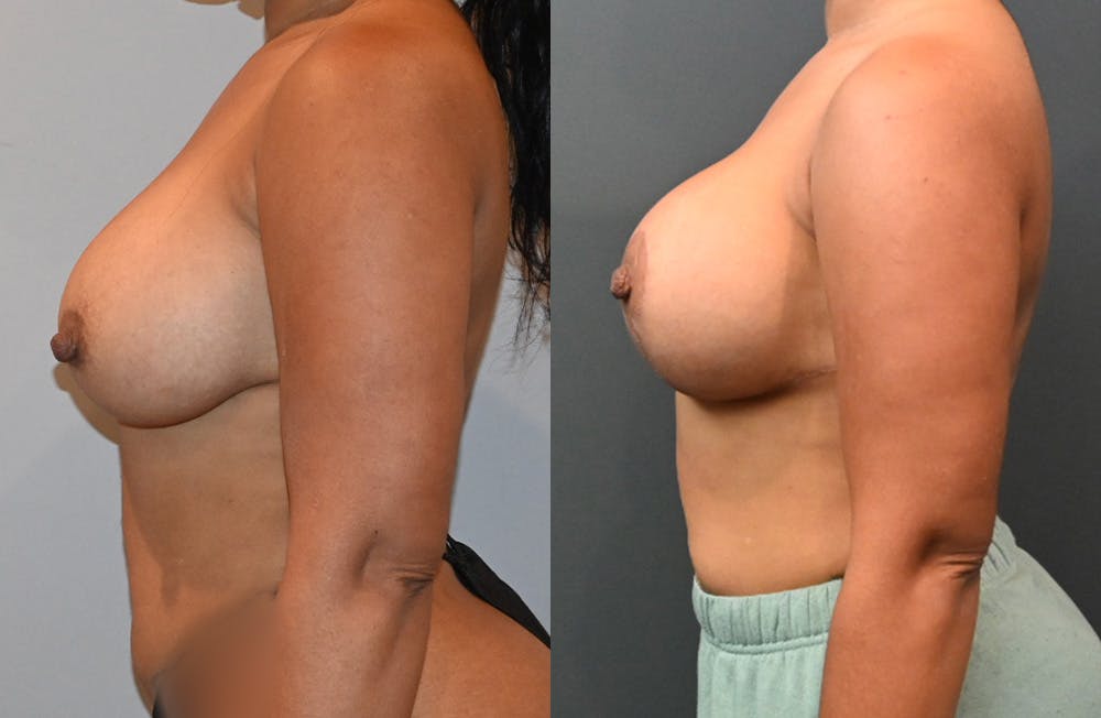 Breast Lift Before & After Photos - Patient 149365442 - Image 3