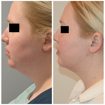 Jawline Contouring  Before & After Photos - Patient 149365462 - Image 1