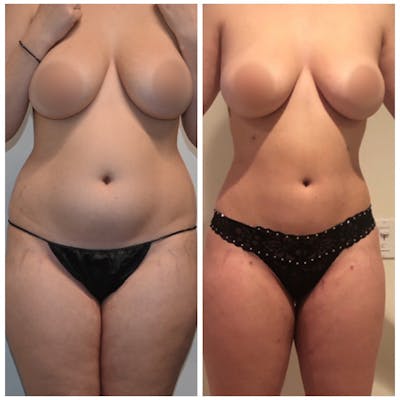 Liposuction Before & After Photos - Patient 149365466 - Image 1