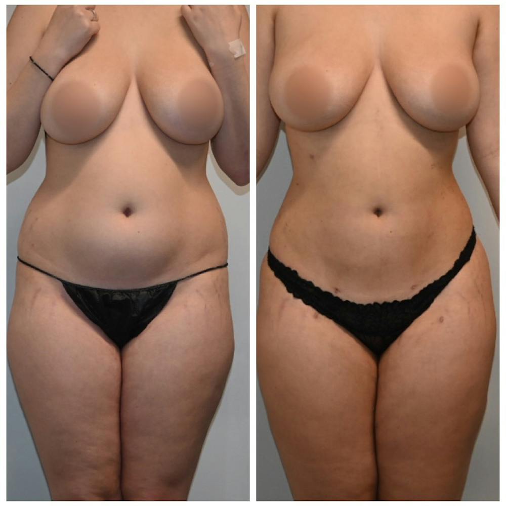 Liposuction Before & After Gallery - Patient 149365466 - Image 2
