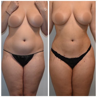 Liposuction Before & After Photos - Patient 149365466 - Image 2
