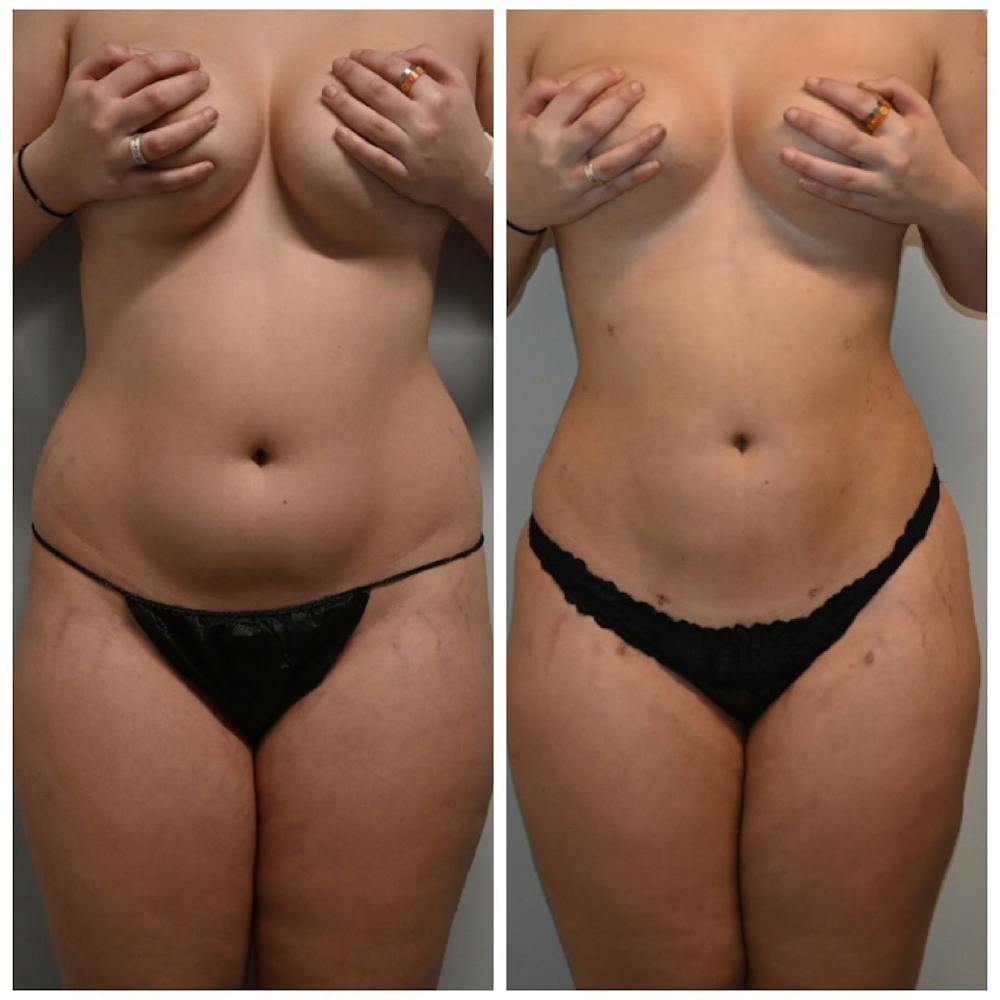 Liposuction Before & After Gallery - Patient 149365466 - Image 3