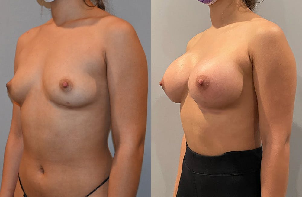 Breast Augmentation  Before & After Gallery - Patient 149365402 - Image 4