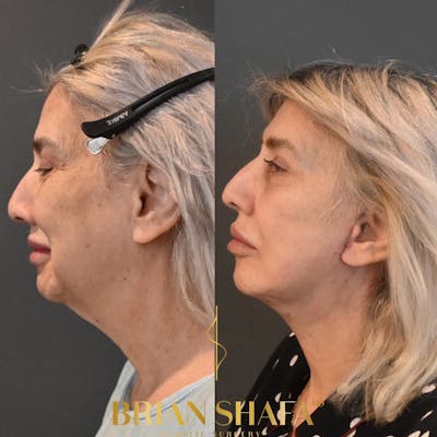 Jawline Contouring  Before & After Gallery - Patient 153890442 - Image 1