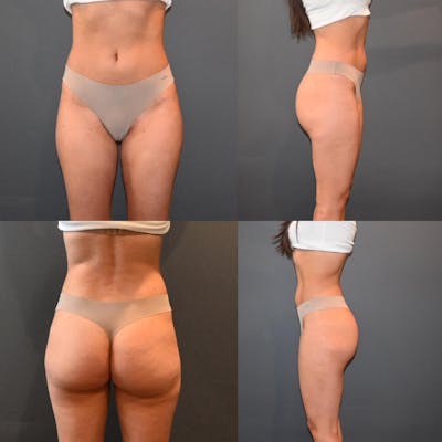 Liposuction Before & After Photos - Patient 153890462 - Image 1