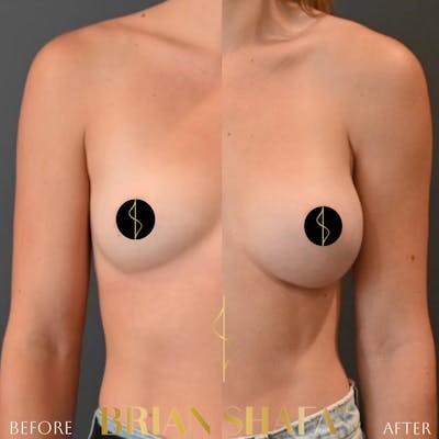 Breast Augmentation  Before & After Photos - Patient 188320050 - Image 1