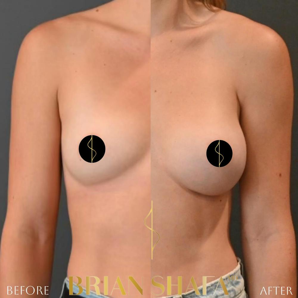Breast Augmentation  Before & After Photos - Patient 188320050 - Image 1