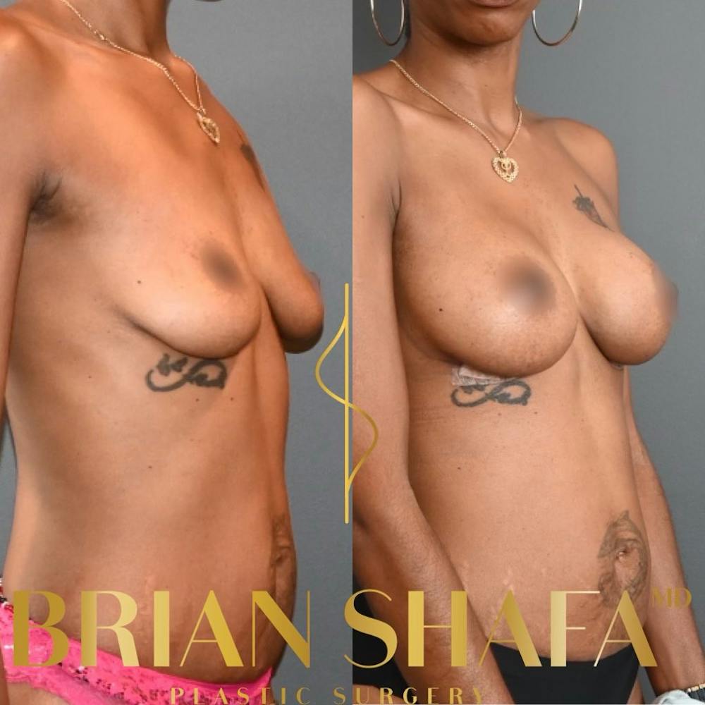 Breast Augmentation  Before & After Gallery - Patient 188320060 - Image 1