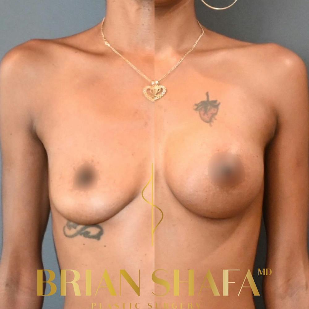 Breast Augmentation  Before & After Gallery - Patient 188320060 - Image 2