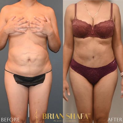 Tummy Tuck (Abdominoplasty) Before & After Photos - Patient 188321179 - Image 1