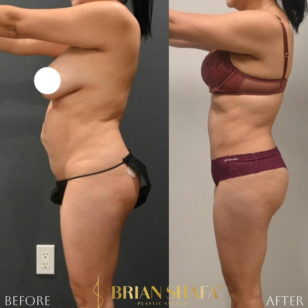 Tummy Tuck (Abdominoplasty) Before & After Gallery - Patient 188321179 - Image 2