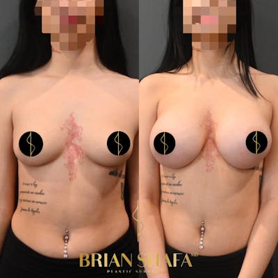 Breast Augmentation  Before & After Photos - Patient 839548 - Image 1