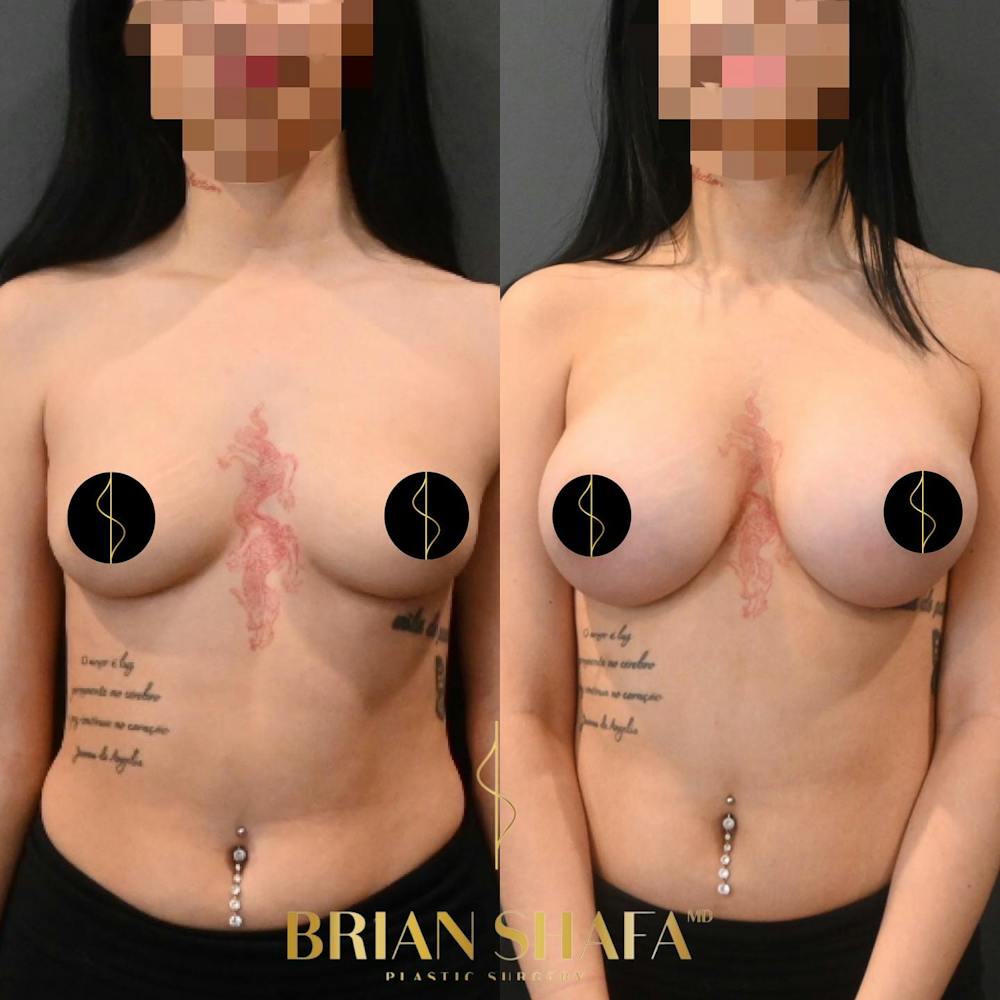 Breast Augmentation  Before & After Gallery - Patient 839548 - Image 1