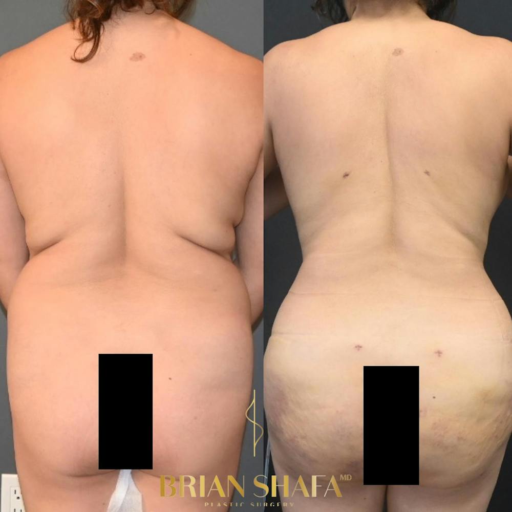 HD Tummy Tuck Before & After Gallery - Patient 196299 - Image 2