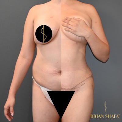 HD Tummy Tuck Before & After Photos - Patient 396108 - Image 1