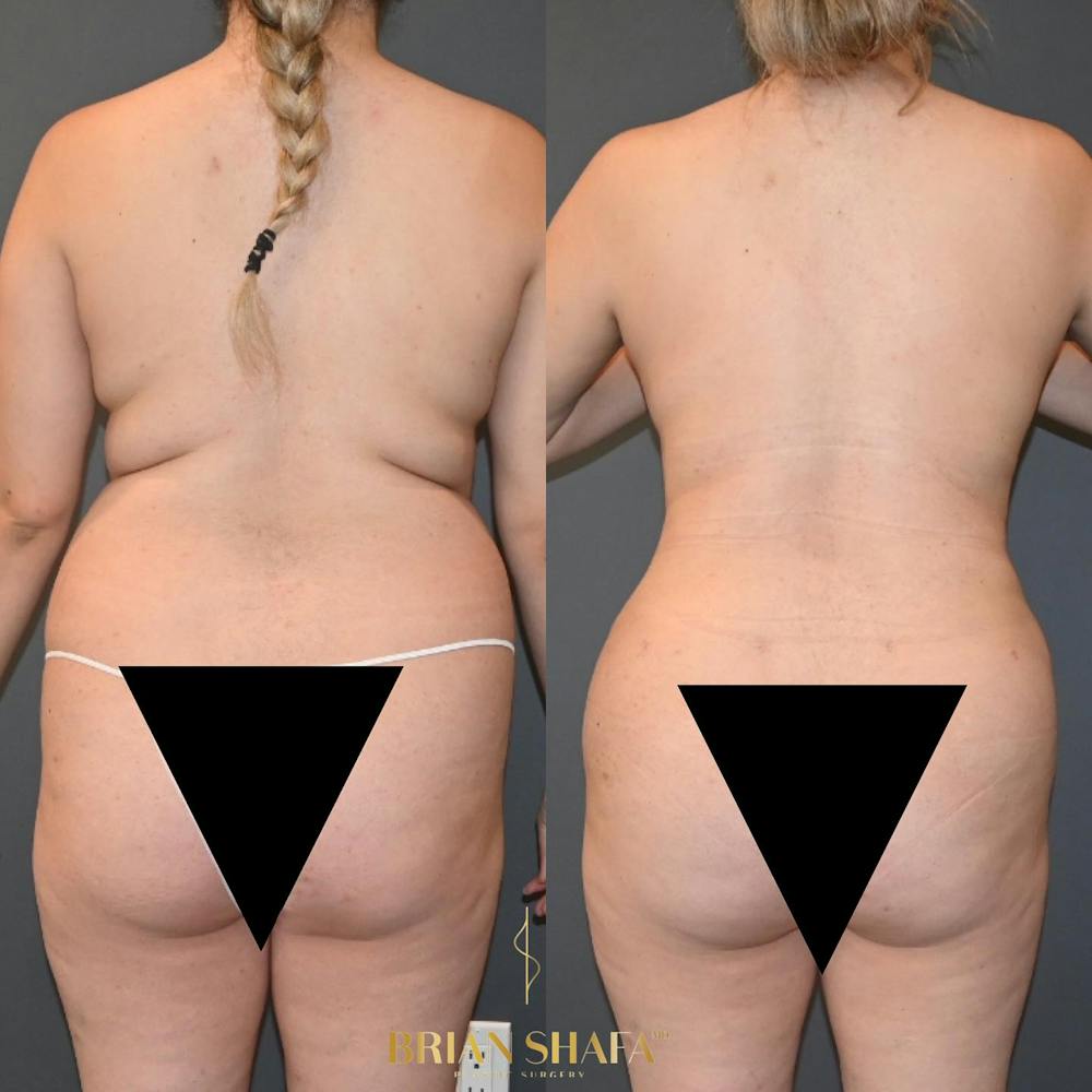 HD Tummy Tuck Before & After Gallery - Patient 396108 - Image 2