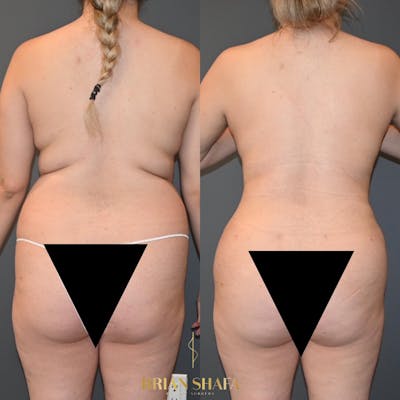 HD Tummy Tuck Before & After Photos - Patient 396108 - Image 2