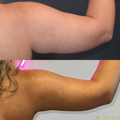 High-Def Liposuction  Before & After Photos - Patient 682654 - Image 1