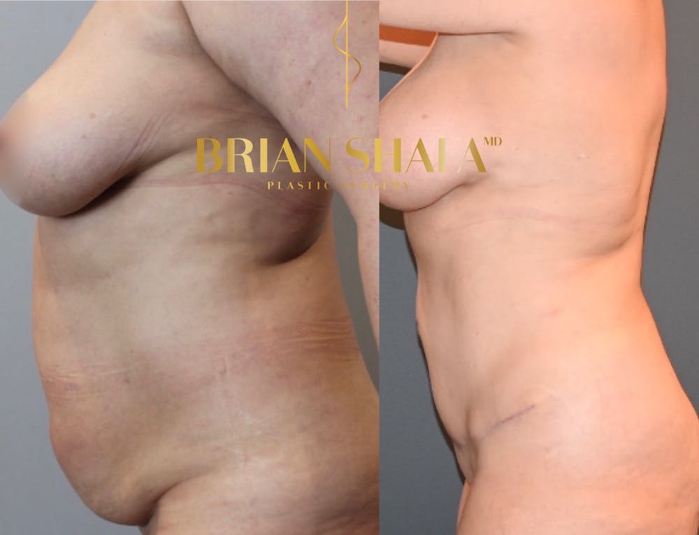 Liposuction Before & After Photos - Patient 146287410 - Image 3