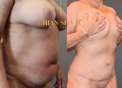 Liposuction Before & After Photos - Patient 146287410 - Image 1