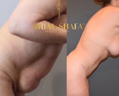 Liposuction Before & After Photos - Patient 146287410 - Image 2
