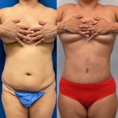 Tummy Tuck (Abdominoplasty) Before & After Photos - Patient 234036 - Image 1