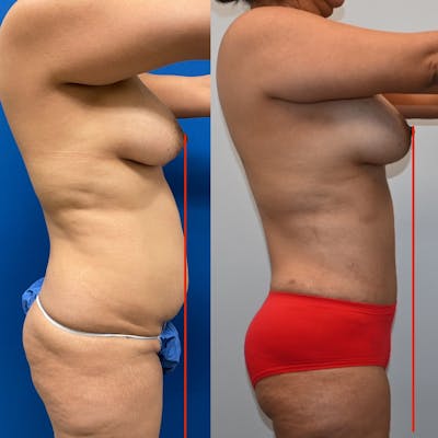 Tummy Tuck (Abdominoplasty) Before & After Photos - Patient 234036 - Image 2