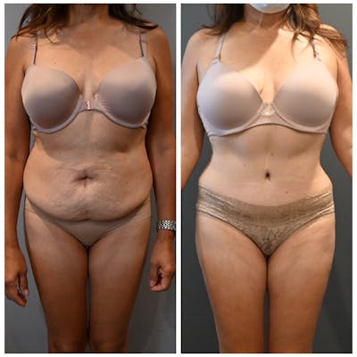 Tummy Tuck (Abdominoplasty) Before & After Photos - Patient 143502966 - Image 1