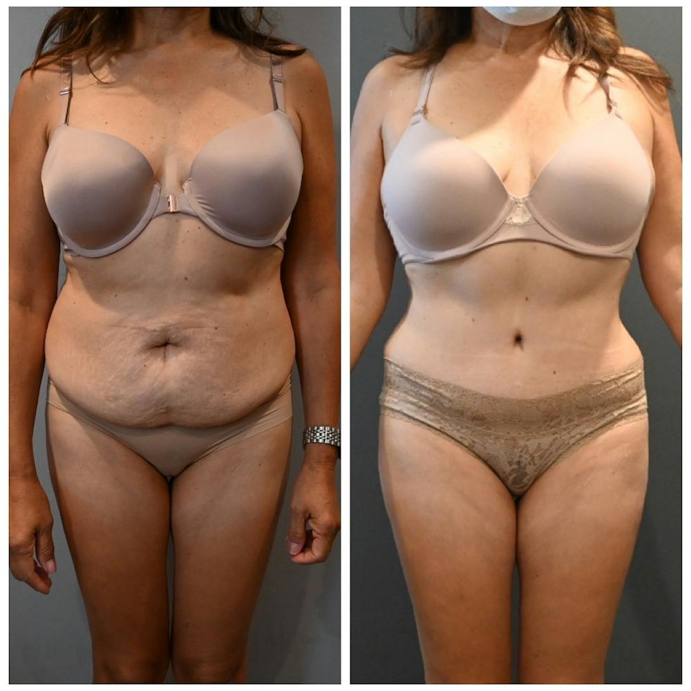 Tummy Tuck (Abdominoplasty) Before & After Gallery - Patient 143502966 - Image 1
