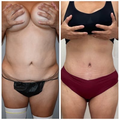 Tummy Tuck (Abdominoplasty) Before & After Photos - Patient 101367 - Image 1