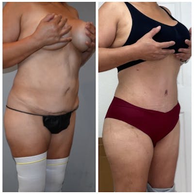 Tummy Tuck (Abdominoplasty) Before & After Photos - Patient 101367 - Image 2