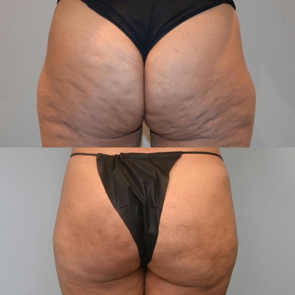 Avéli™ Cellulite Reduction Before & After Gallery - Patient 574547 - Image 1
