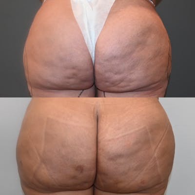 Avéli™ Cellulite Reduction Before & After Gallery - Patient 388028 - Image 1