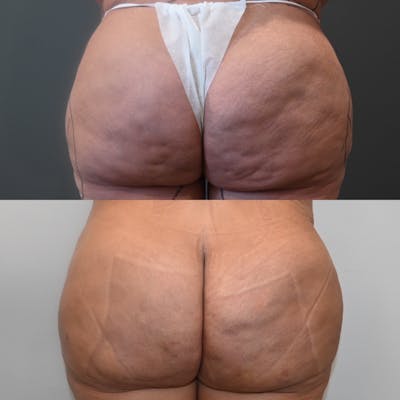 Avéli™ Cellulite Reduction Before & After Photos - Patient 152063 - Image 1